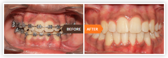 teeth aligners