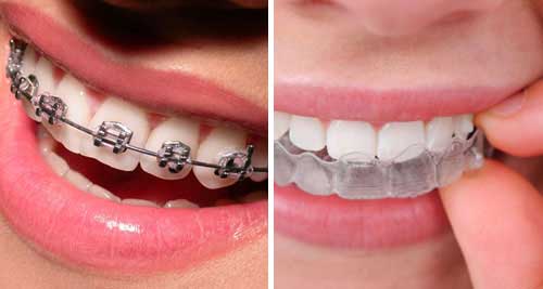 teeth aligners