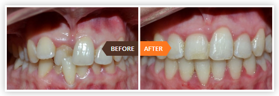 teeth aligners