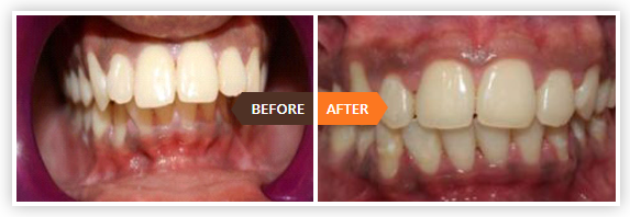 teeth aligners