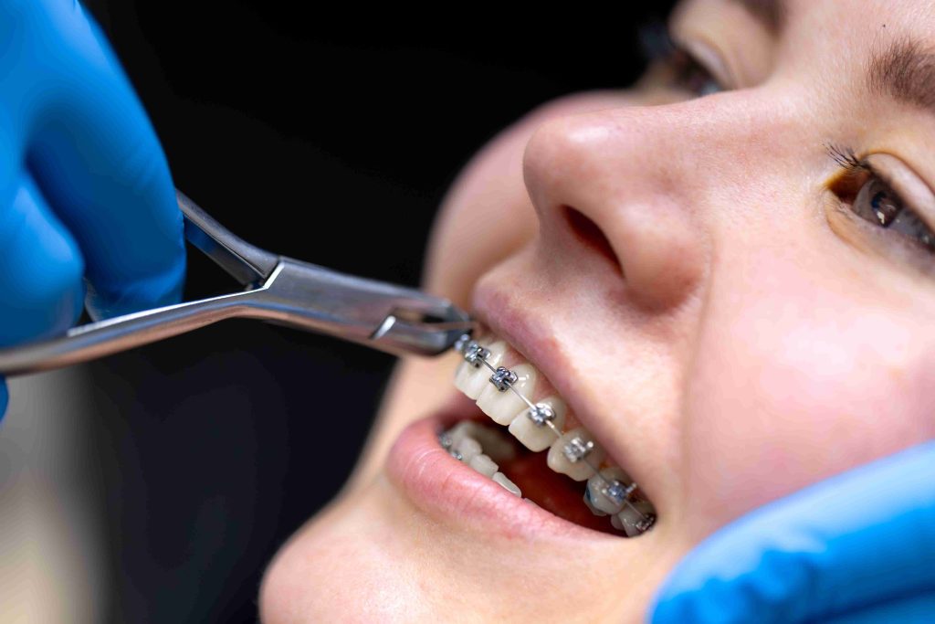 Orthodontic treatment in Hyderabad
